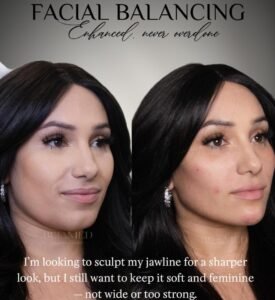 Lifting facial no quirúrgico: Equilibrio facial