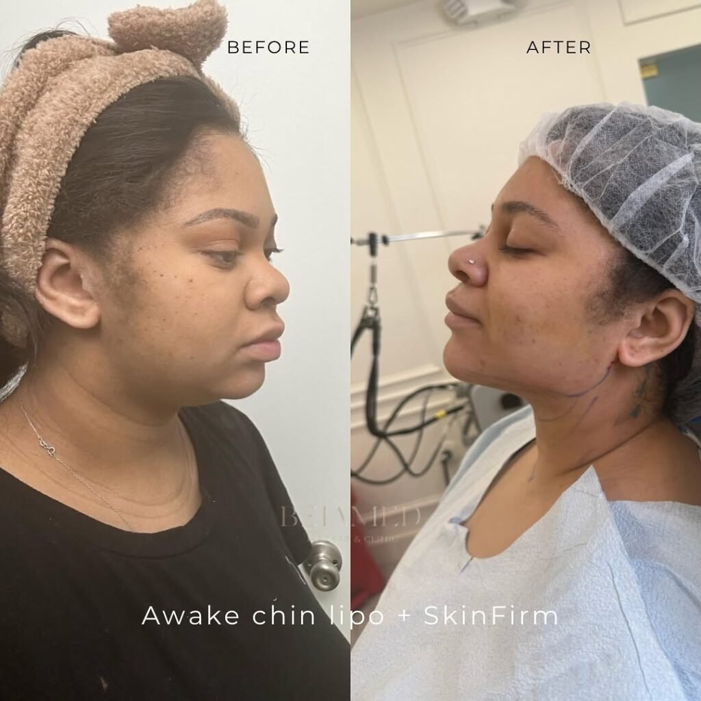 Awake Lipo