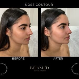 liquid nose job results BEIAMED