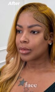 After PRF EZ Gel at BEIAMED