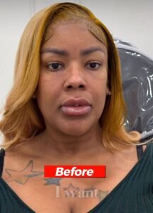 Before PRF EZ Gel at BEIAMED