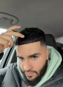 After DHI Hair Transplant at BEIAMED