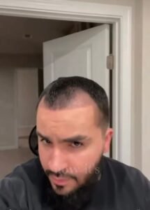 Before DHI Hair Transplant at BEIAMED