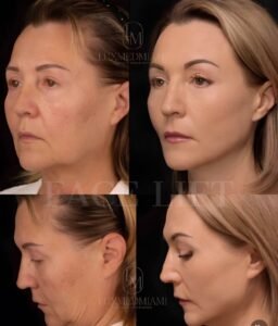 Facelift surgery