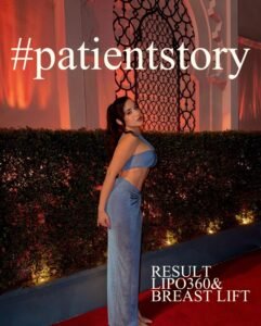 Lipo 360 + Breast lift BEIAMED patient story 1