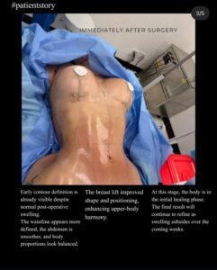 Lipo 360 + Breast lift BEIAMED patient story 4