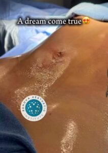 Lipo Marcación 4K + BBL después de 1