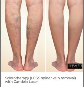 Escleroterapia (Extirpación de una araña de las piernas)