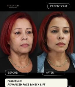 Lifting avanzado de cara y cuello