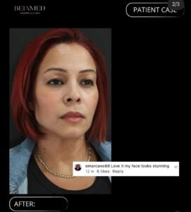 Lifting avanzado de cara y cuello