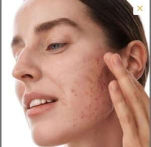 Acne Facials