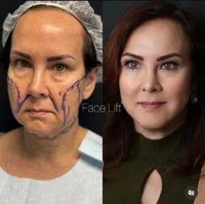 A Comprehensive Facelift Package