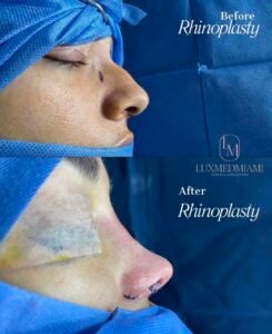 Rinoplastia: Antes y después