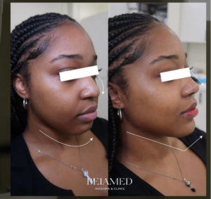 Facial Balancing Miami