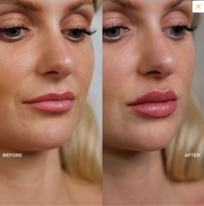 ¿Merece la pena el relleno de labios