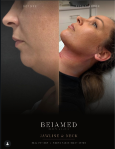 Nonsurgical Treatments Before an Event
