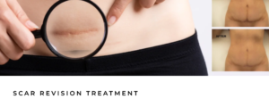 scar revision in Miami