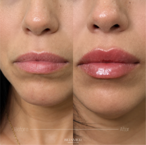 maquillaje después de los rellenos