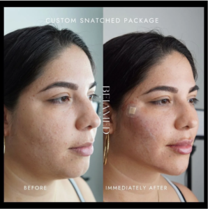 pdo thread lift in Miami